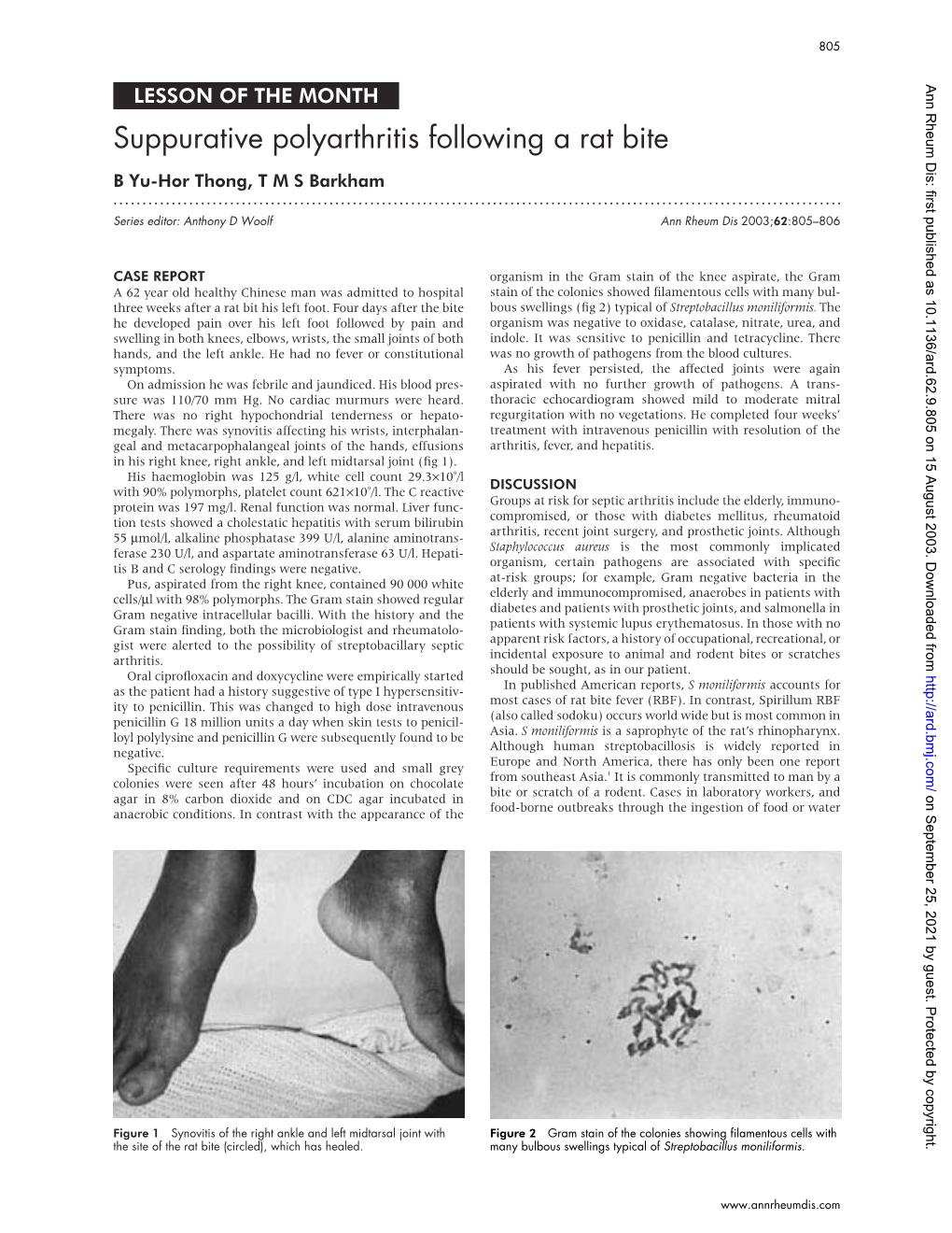 Suppurative Polyarthritis Following a Rat Bite