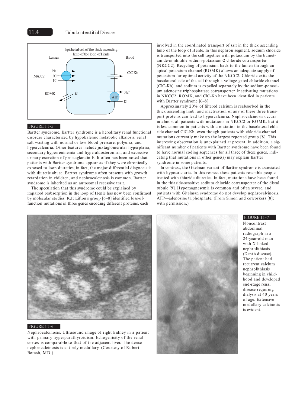 Tubulointerstitial Disease