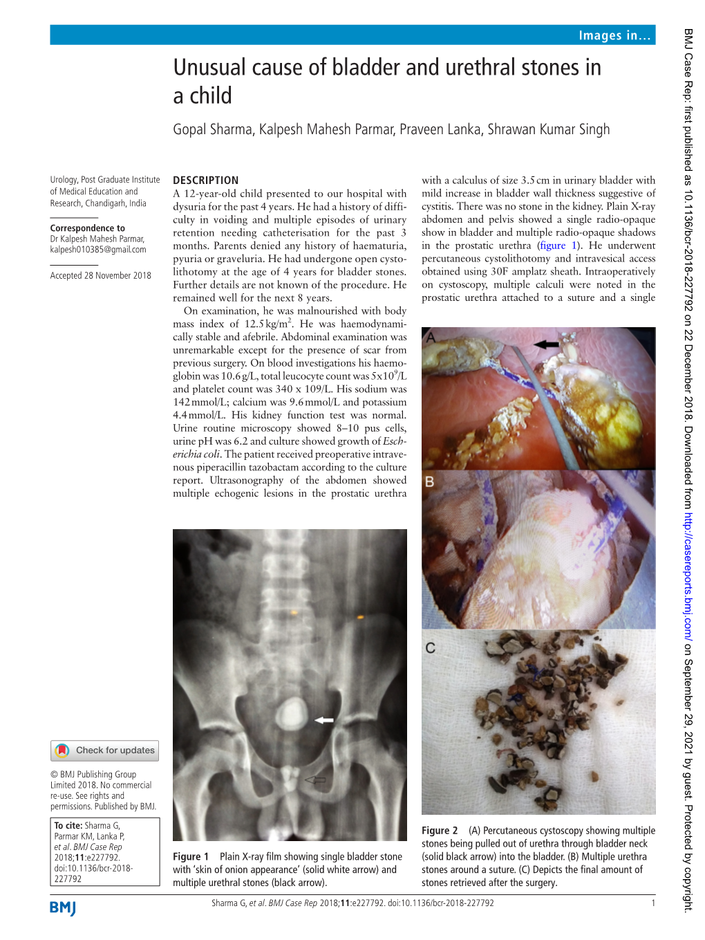 Unusual Cause of Bladder and Urethral Stones in a Child Gopal Sharma, Kalpesh Mahesh Parmar, Praveen Lanka, Shrawan Kumar Singh