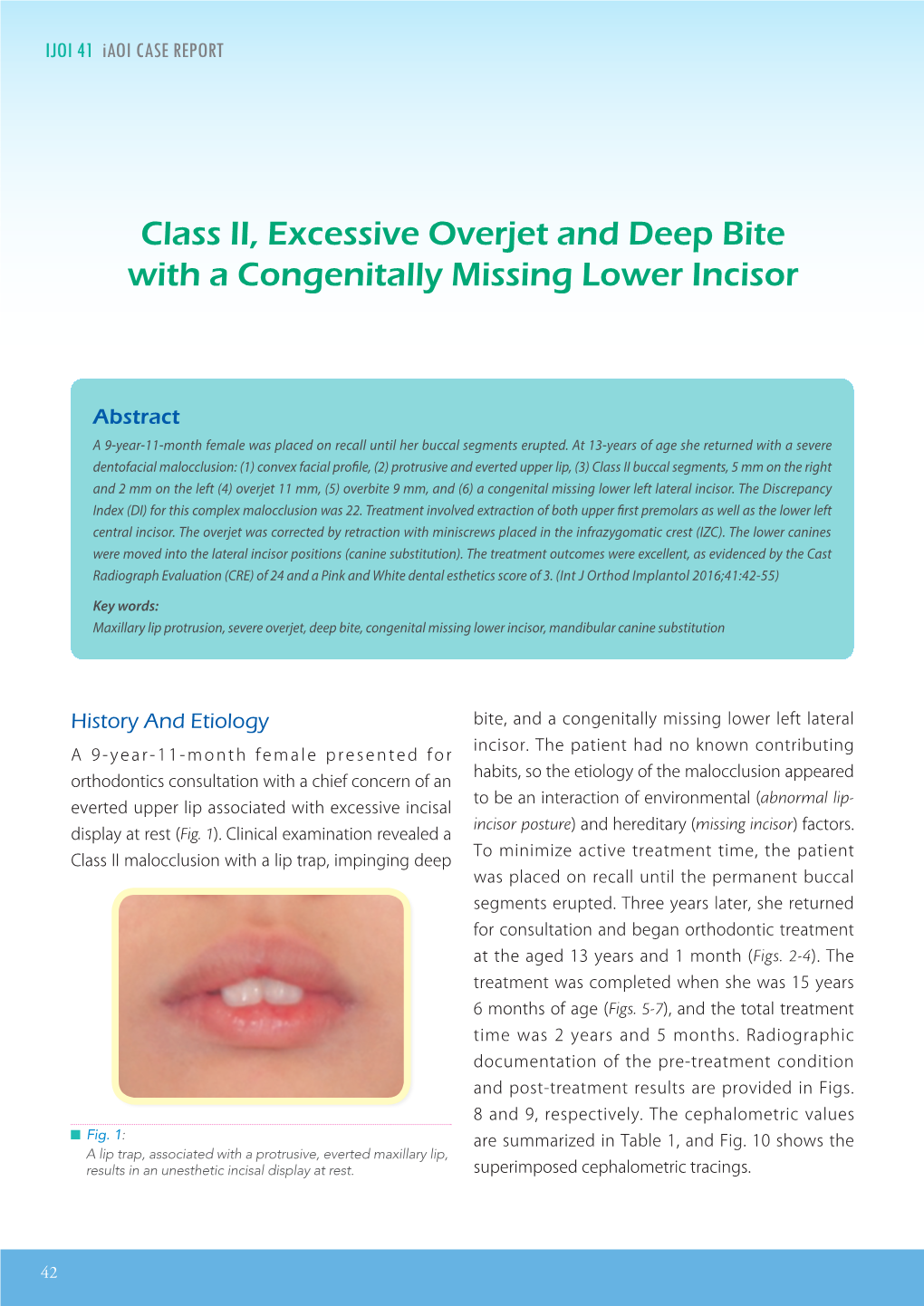 Class II, Excessive Overjet and Deep Bite with a Congenitally Missing Lower Incisor IJOI 41