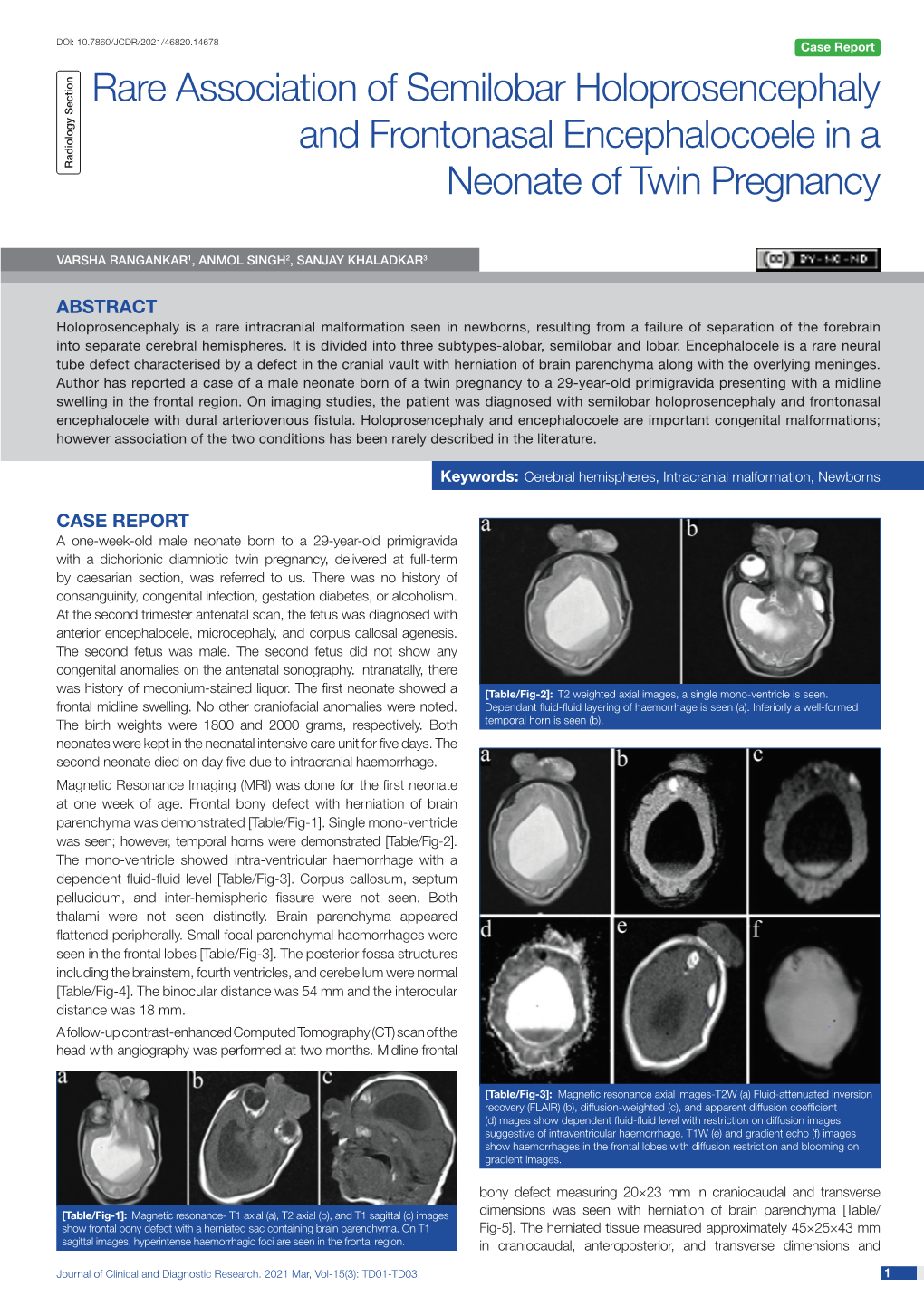 Rare Association of Semilobar Holoprosencephaly and Frontonasal Encephalocoele in a Radiology Section Neonate of Twin Pregnancy