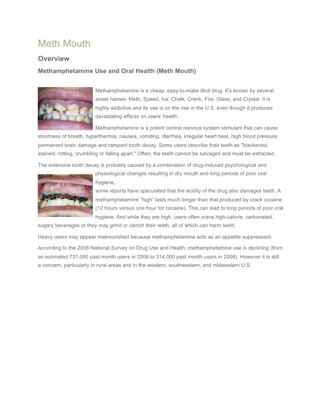 Meth Mouth Overview Methamphetamine Use and Oral Health (Meth Mouth)