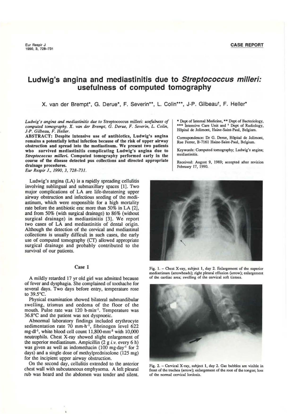 Ludwig's Angina and Mediastinitis Due to Streptococcus Milleri: Usefulness of Computed Tomography
