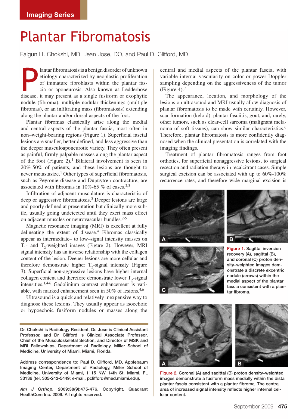 Plantar Fibromatosis