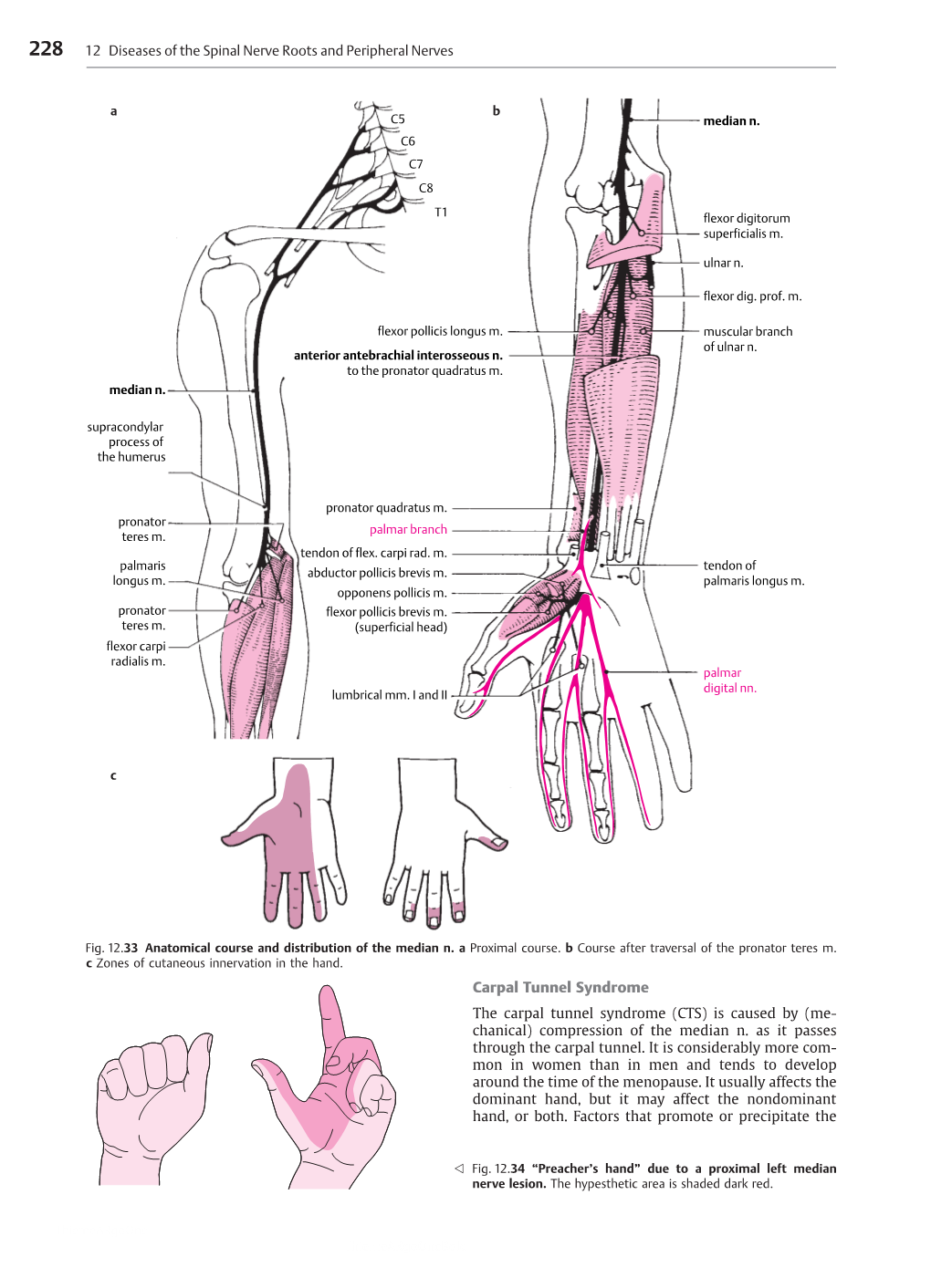 Carpal Tunnel Syndrome the Carpal Tunnel Syndrome (CTS) Is Caused by (Me- Chanical) Compression of the Median N