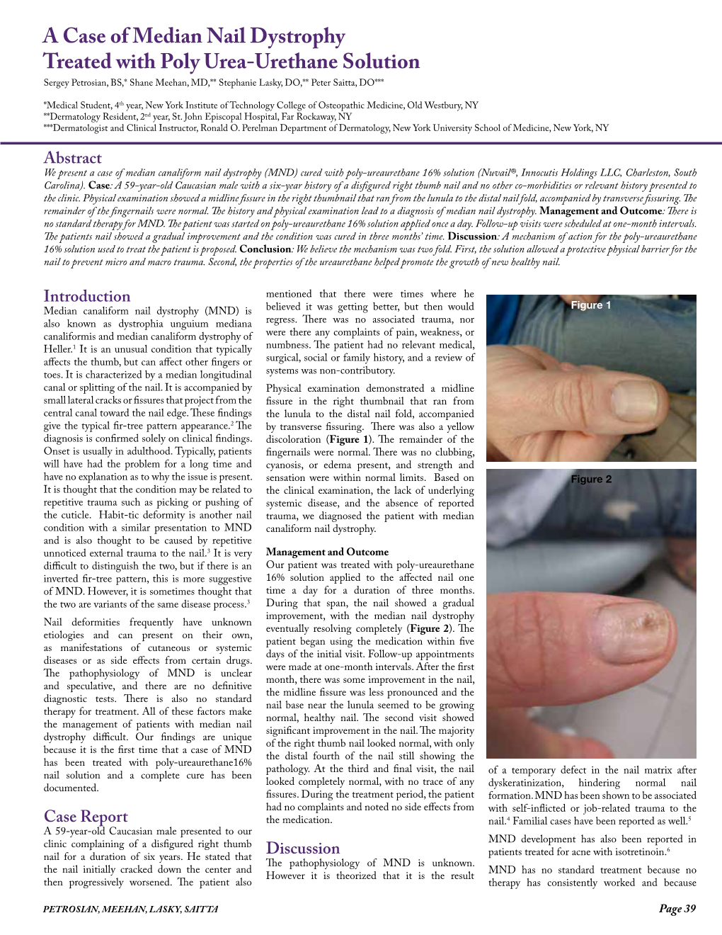 A Case of Median Nail Dystrophy Treated with Poly Urea-Urethane Solution Sergey Petrosian, BS,* Shane Meehan, MD,** Stephanie Lasky, DO,** Peter Saitta, DO***