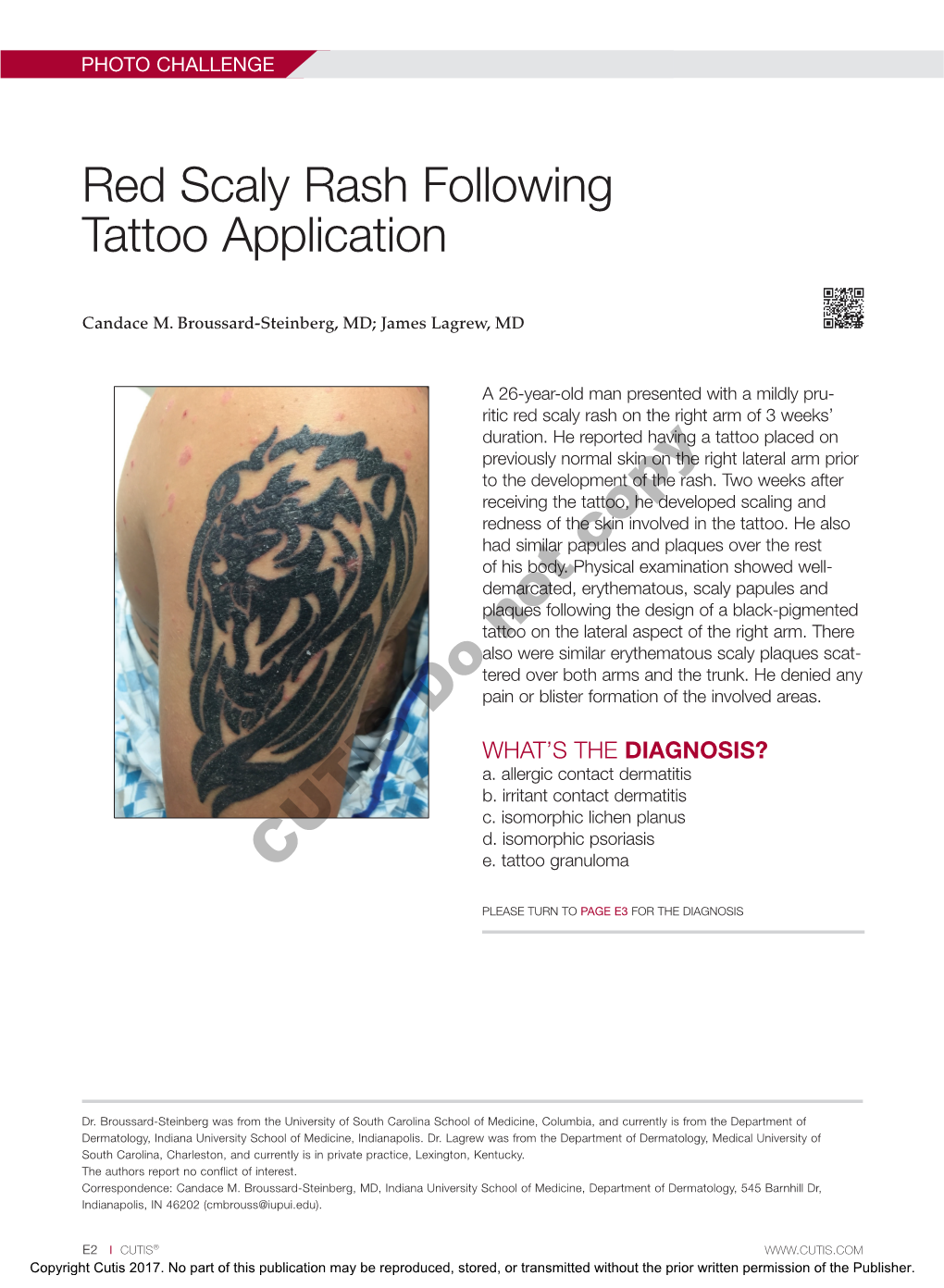 Red Scaly Rash Following Tattoo Application