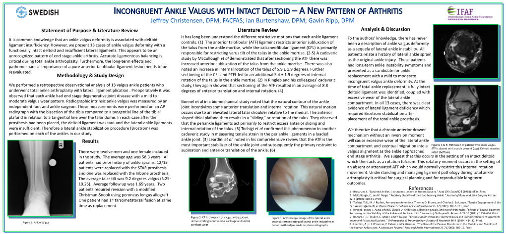 Incongruent Ankle Valgus with Intact Deltoid