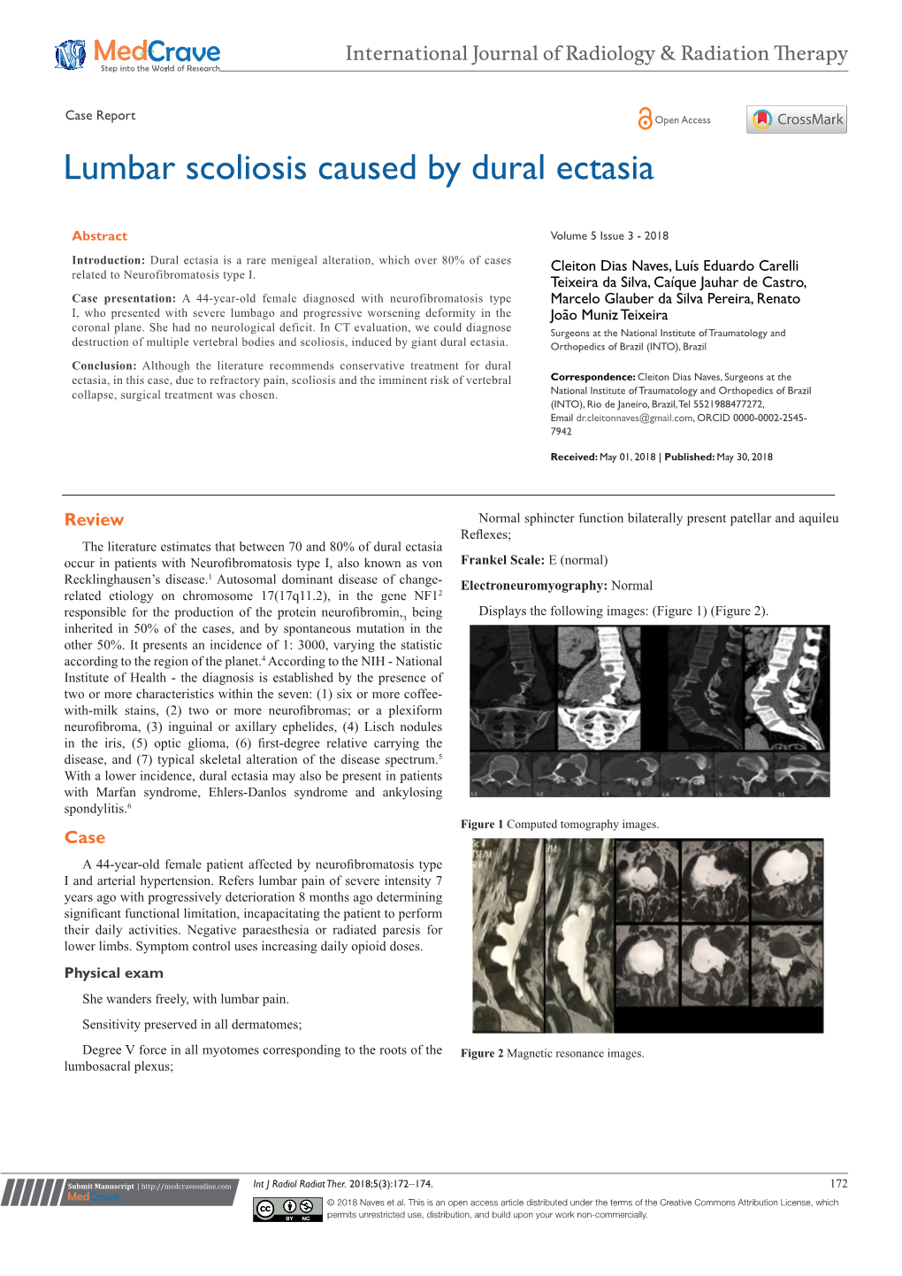 Lumbar Scoliosis Caused by Dural Ectasia