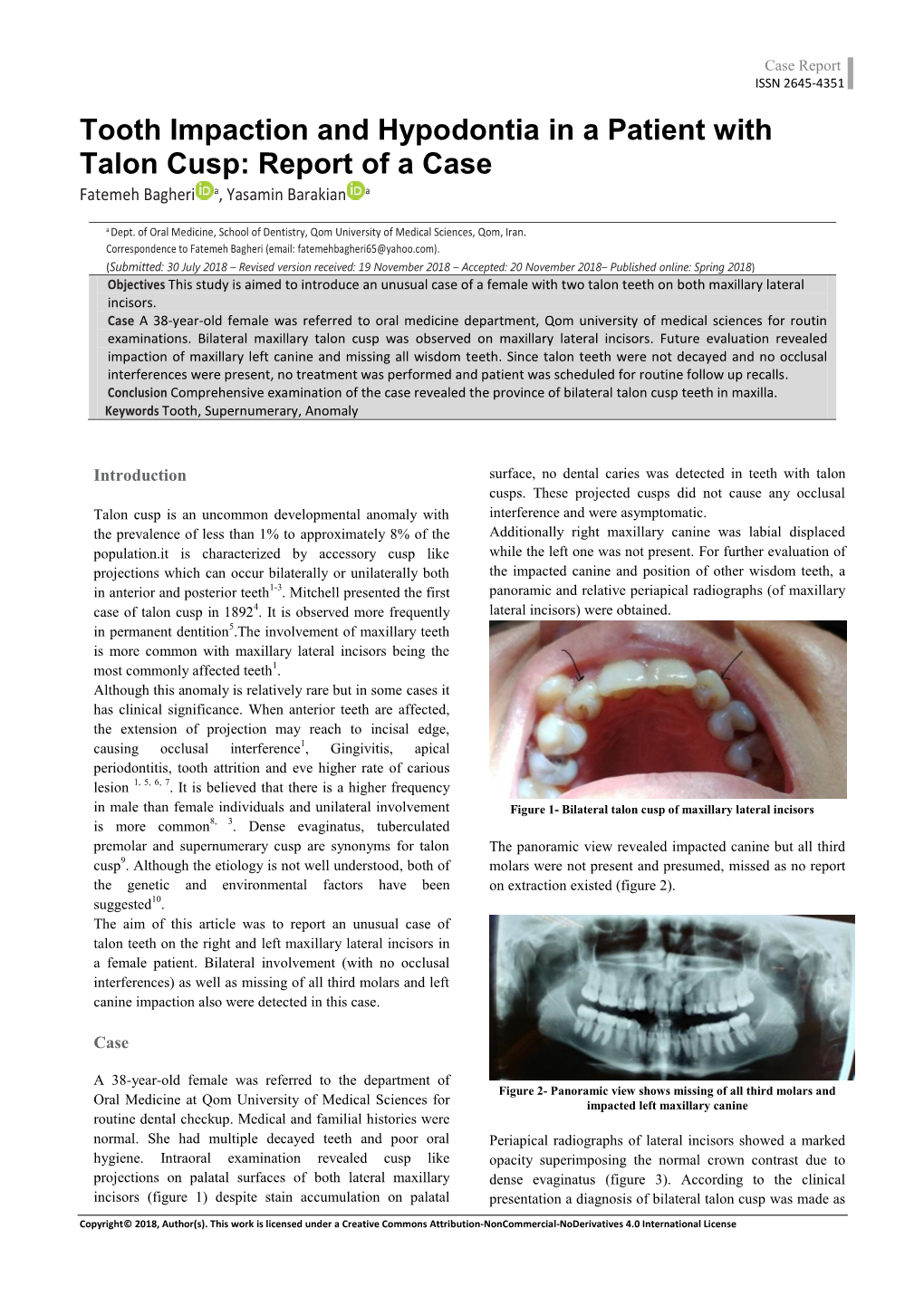 Tooth Impaction and Hypodontia in a Patient with Talon Cusp: Report of a Case a a Fatemeh Bagheri , Yasamin Barakian