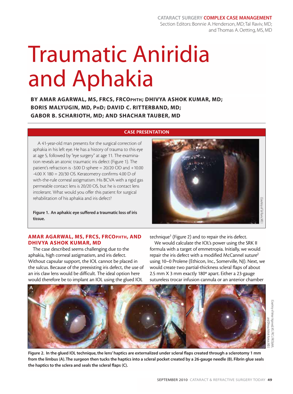 Traumatic Aniridia and Aphakia