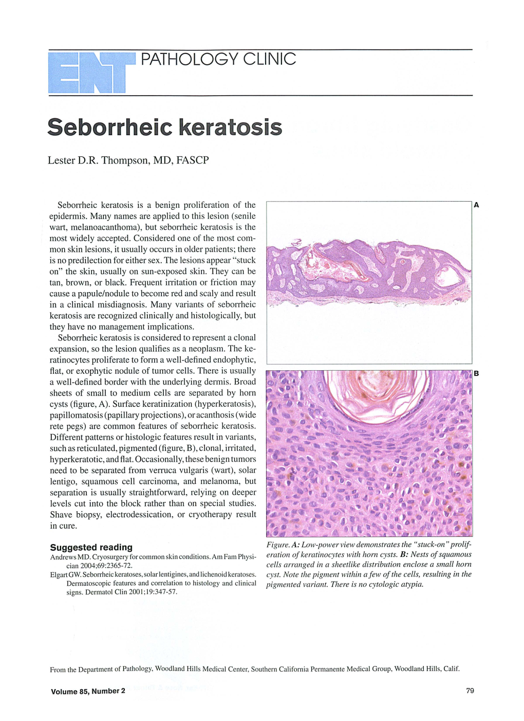 Seborrheic Keratosis