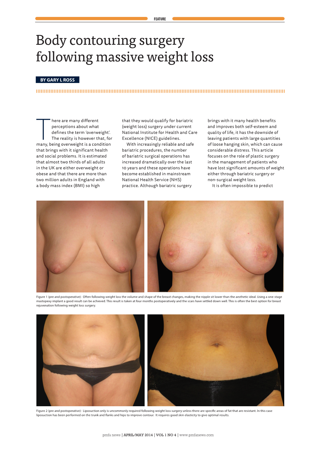 Body Contouring Surgery Following Massive Weight Loss