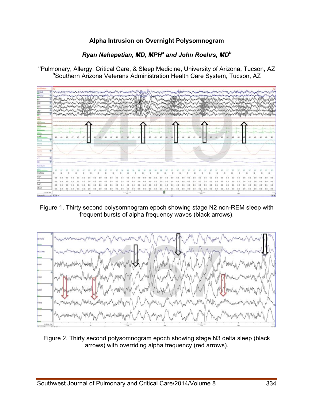 Alpha Intrusion on Overnight Polysomnogram Ryan Nahapetian