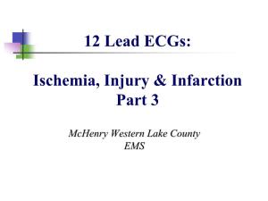 12 Lead Ecgs: Ischemia, Injury & Infarction Part 3