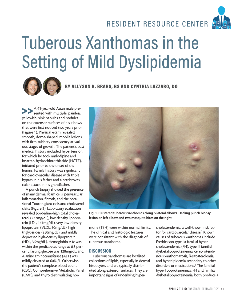 Tuberous Xanthomas in the Setting of Mild Dyslipidemia
