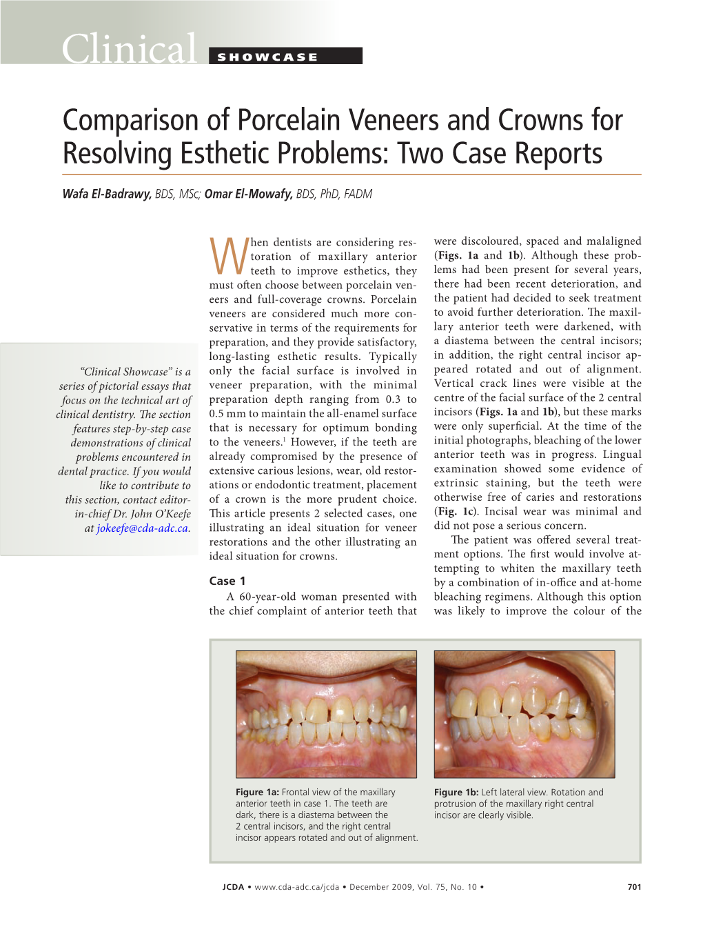 Comparison of Porcelain Veneers and Crowns for Resolving Esthetic Problems: Two Case Reports