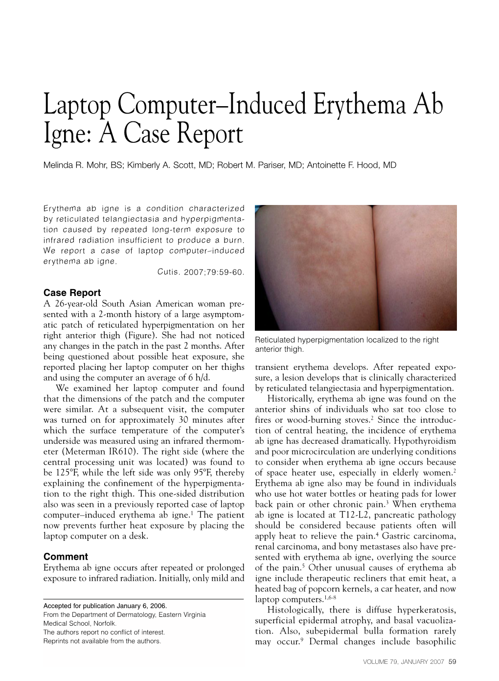 Laptop Computer–Induced Erythema Ab Igne: a Case Report