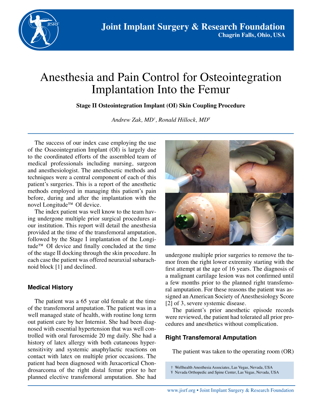 Anesthesia and Pain Control for Osteointegration Implantation Into the Femur Stage II Osteointegration Implant (OI) Skin Coupling Procedure