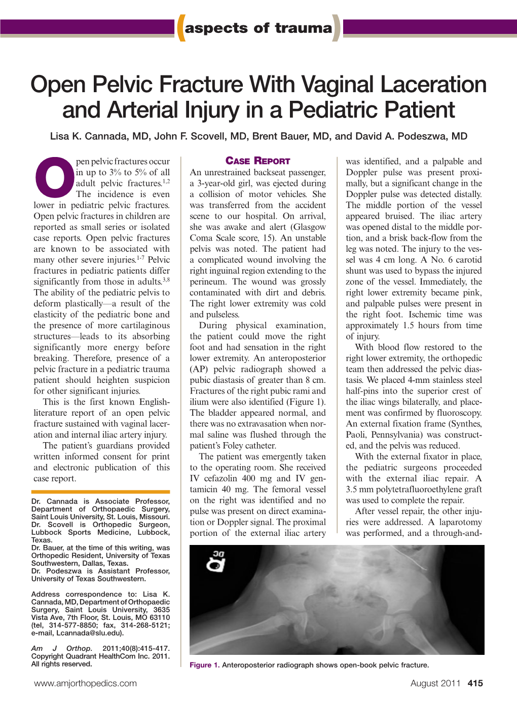 Open Pelvic Fracture with Vaginal Laceration and Arterial Injury in a Pediatric Patient Lisa K