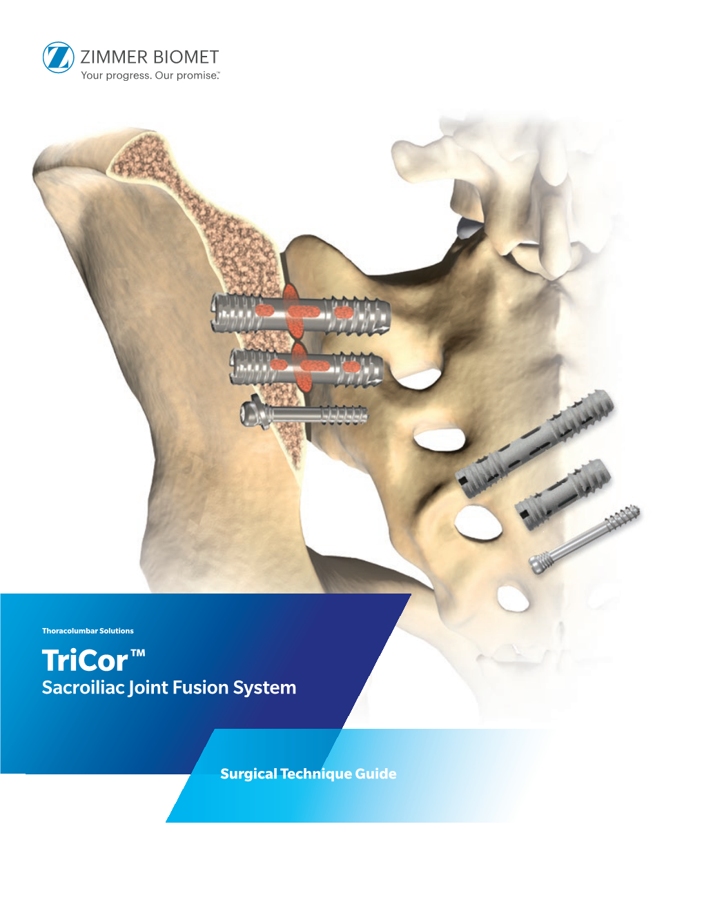 Tricor™ Sacroiliac Joint Fusion System Surgical Technique Guide
