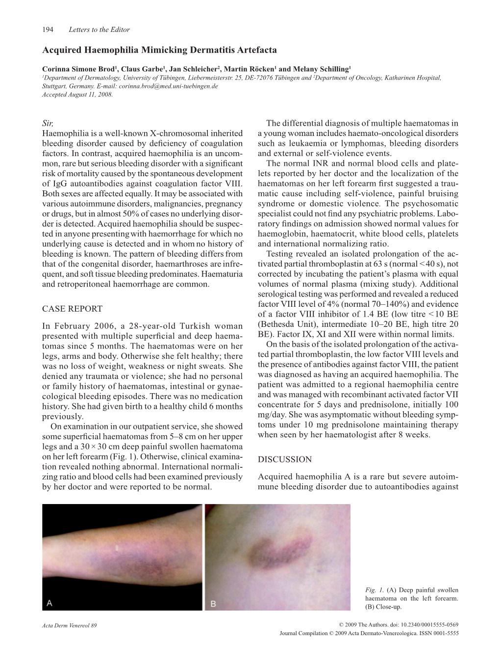 Acquired Haemophilia Mimicking Dermatitis Artefacta