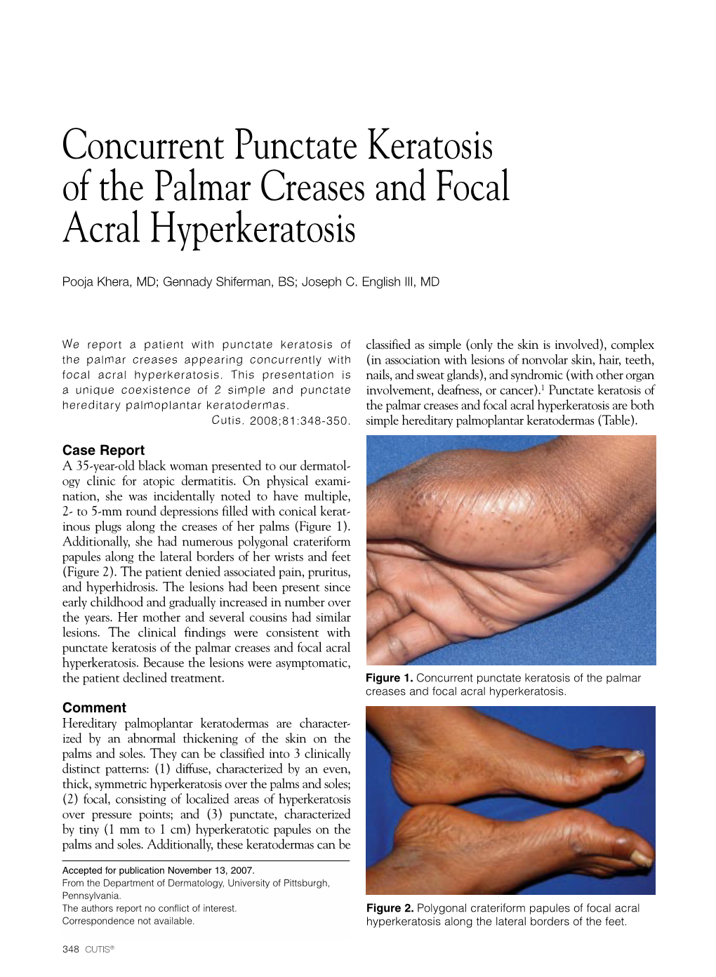Concurrent Punctate Keratosis of the Palmar Creases and Focal Acral Hyperkeratosis