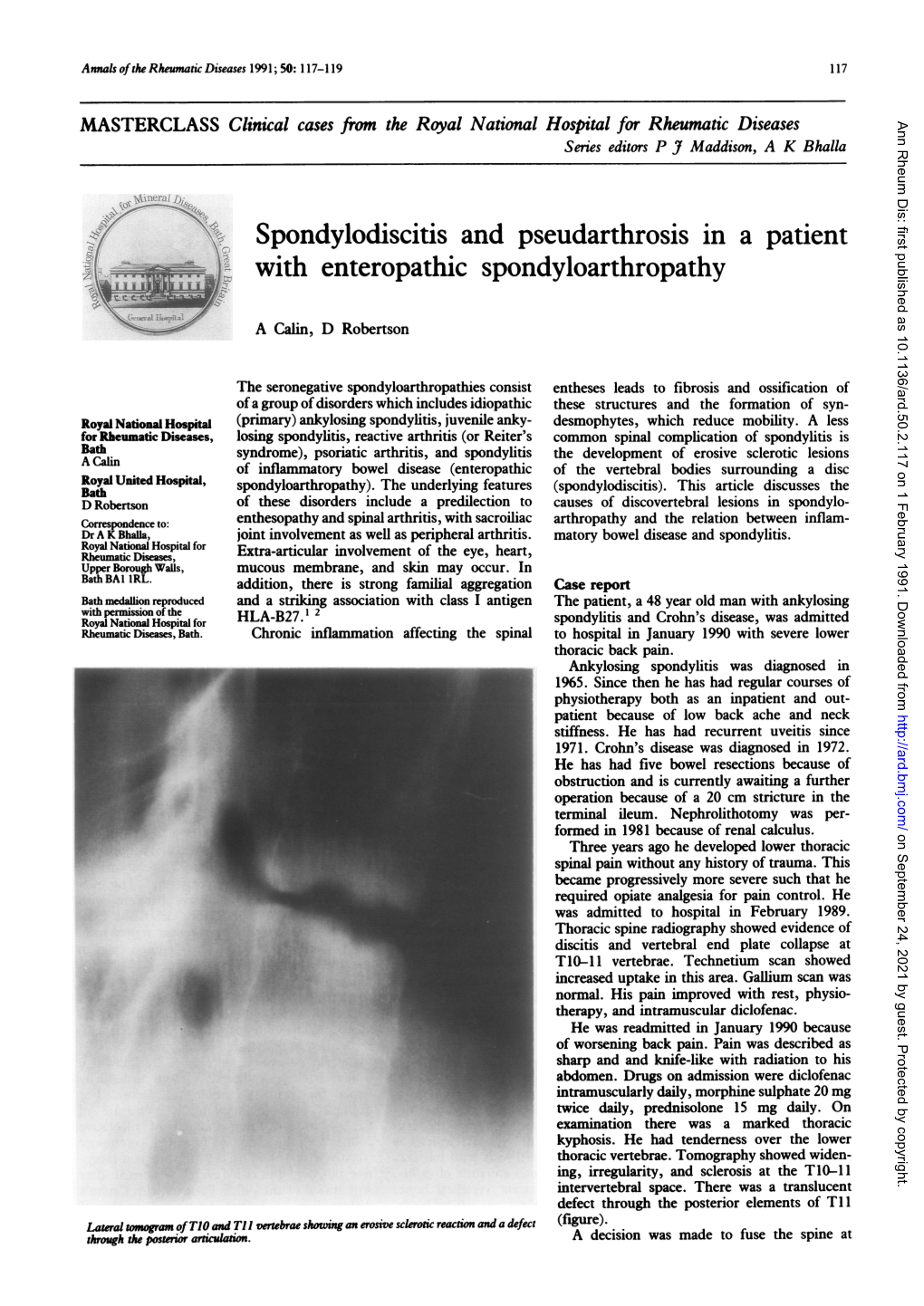 Spondylodiscitis Andpseudarthrosis in a Patient with Enteropathic