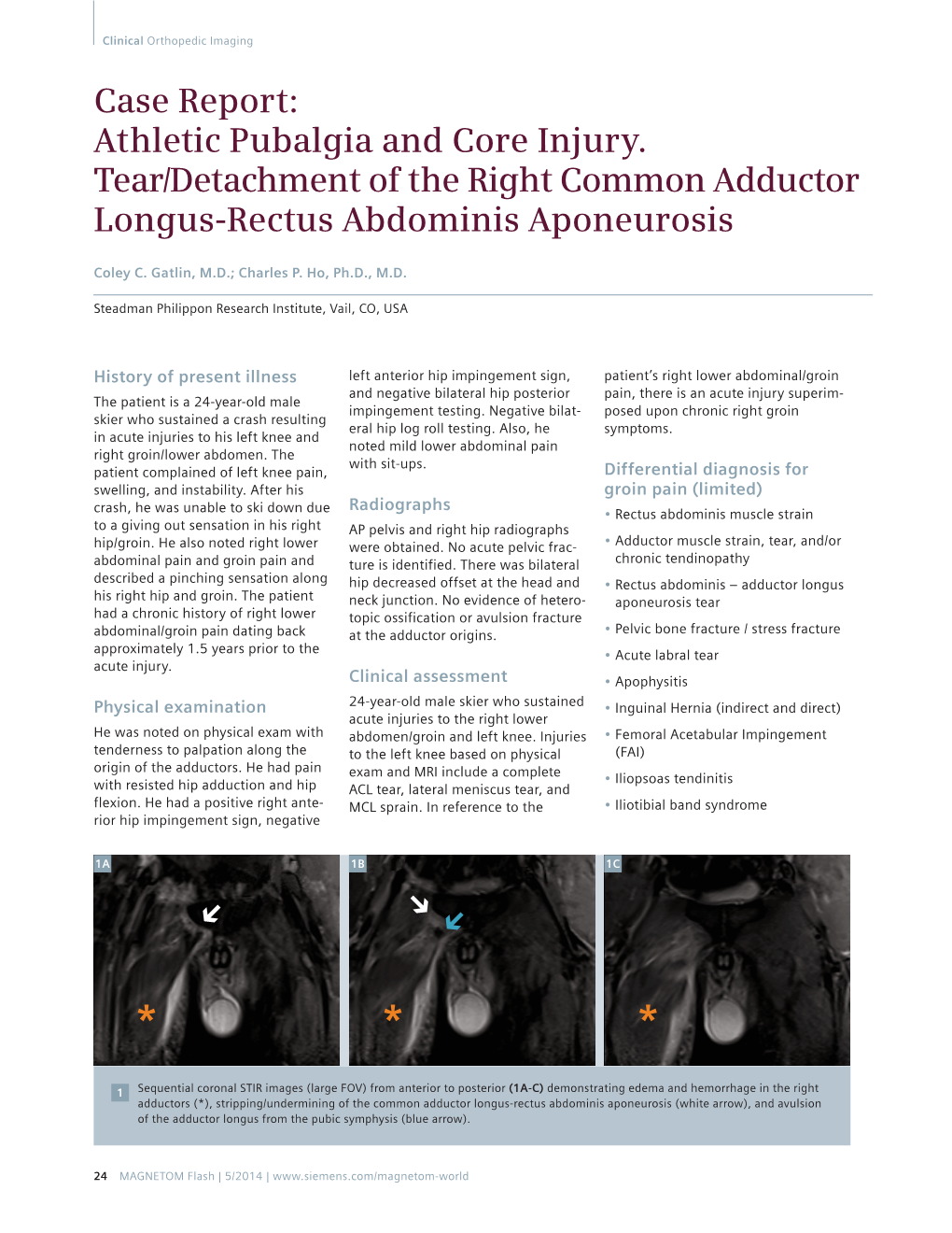 Case Report: Athletic Pubalgia and Core Injury. Tear/Detachment of the Right Common Adductor Longus-Rectus Abdominis Aponeurosis