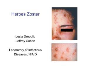 Herpes Zoster by Lesia Dropulic, MD