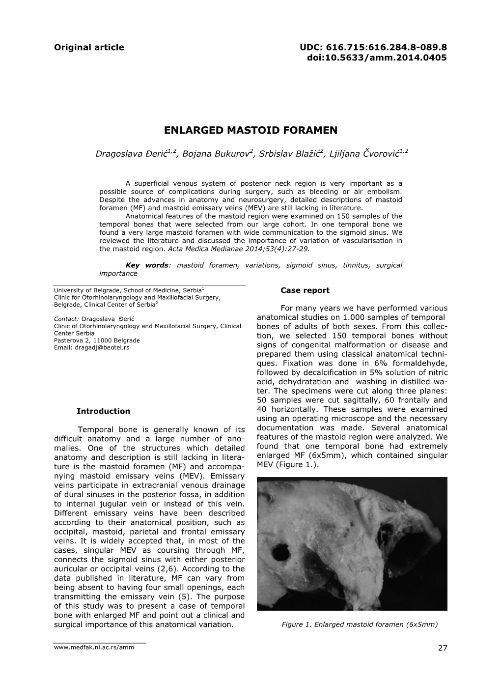 Enlarged Mastoid Foramen