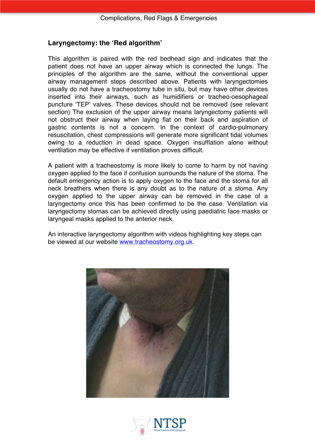 Emergency Laryngectomy Management Call for Airway Expert Help Look, Listen & Feel at the Mouth and Laryngectomy Stoma a Mapleson C System (E.G