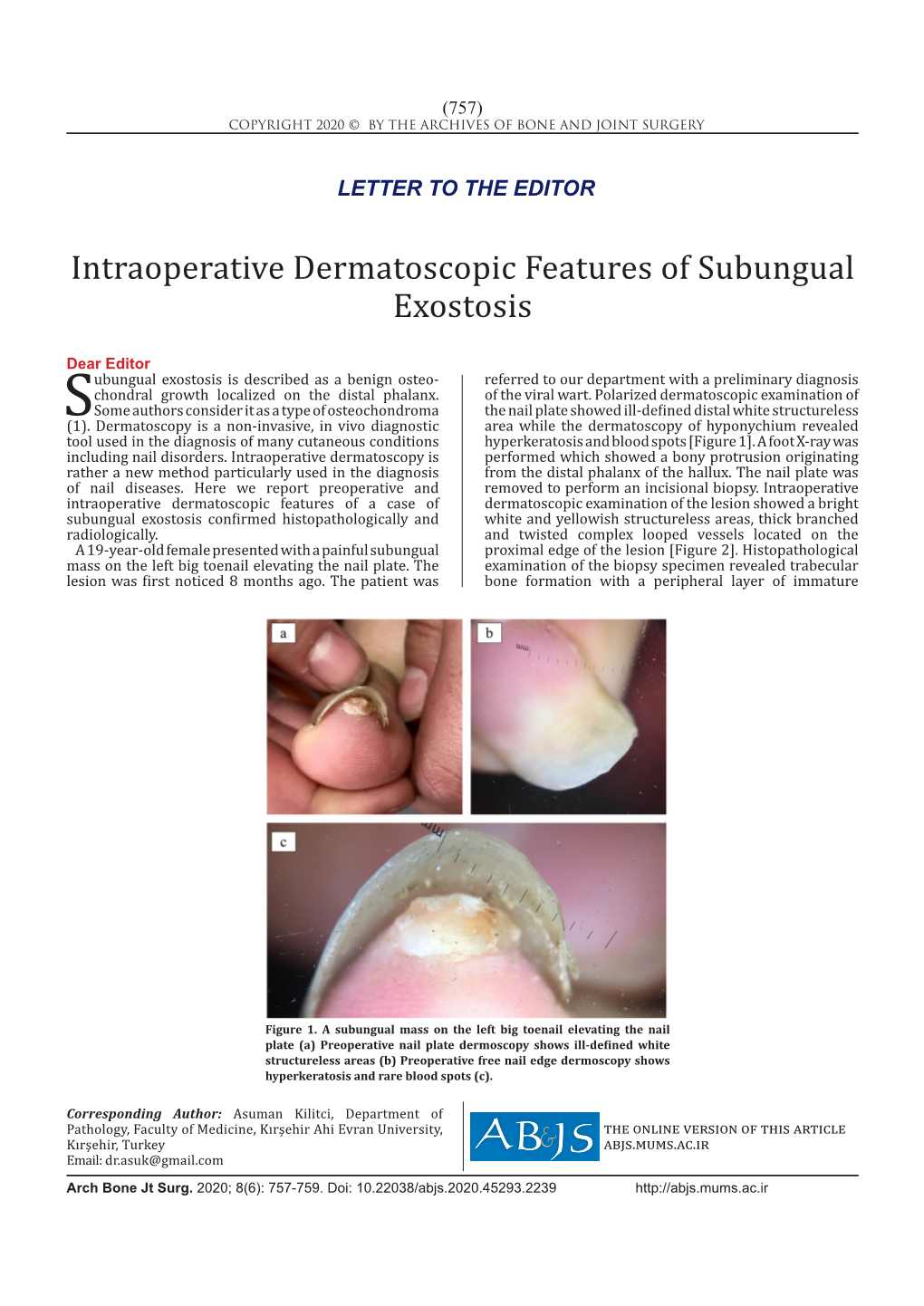 Intraoperative Dermatoscopic Features of Subungual Exostosis Have Never Been Identified Previously