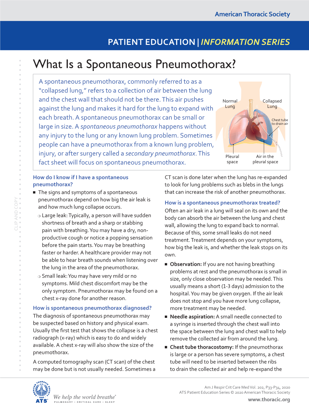 What Is a Spontaneous Pneumothorax?