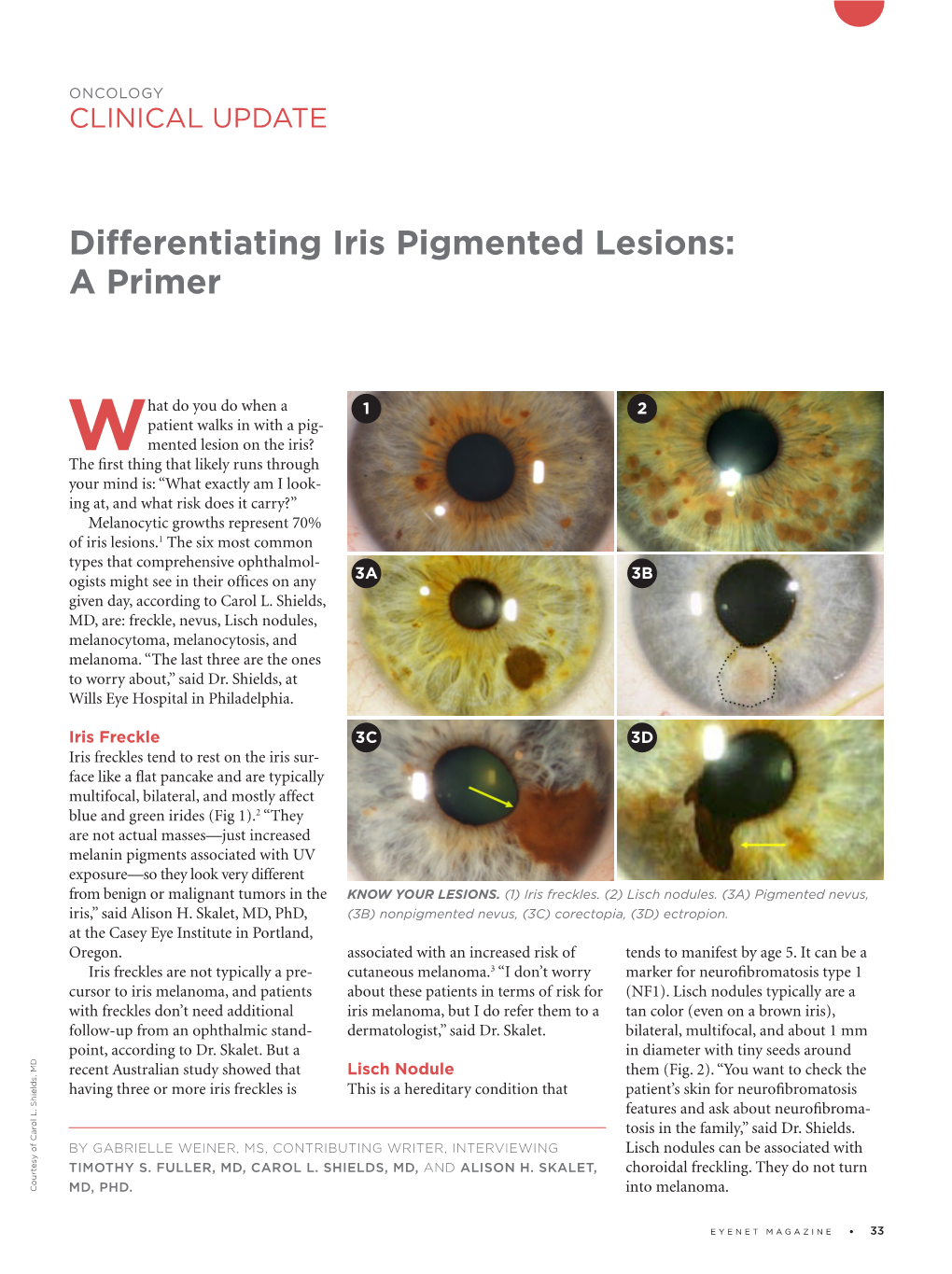 Differentiating Iris Pigmented Lesions: a Primer