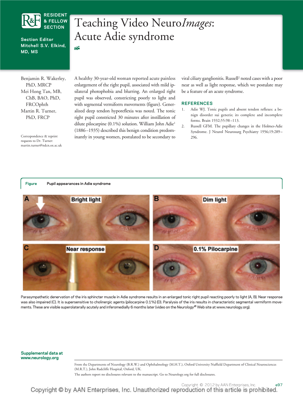 Acute Adie Syndrome Mitchell S.V