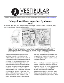 Enlarged Vestibular Aqueduct Syndrome (EVAS) by Hamid, MD, Phd, EE, the Cleveland Hearing & Balance Center, Lyndhurst, OH; and the Vestibular Disorders Association