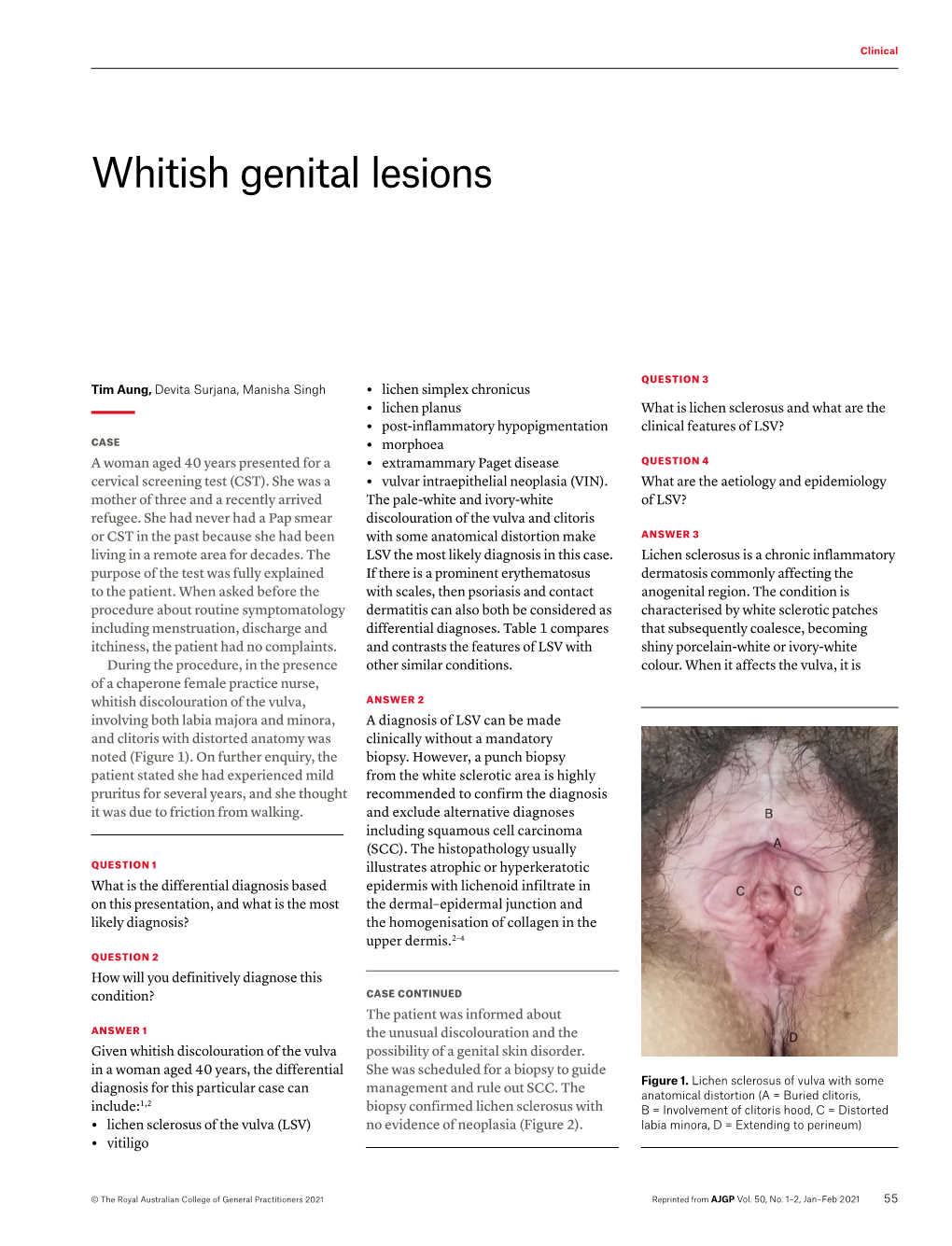 Whitish Genital Lesions