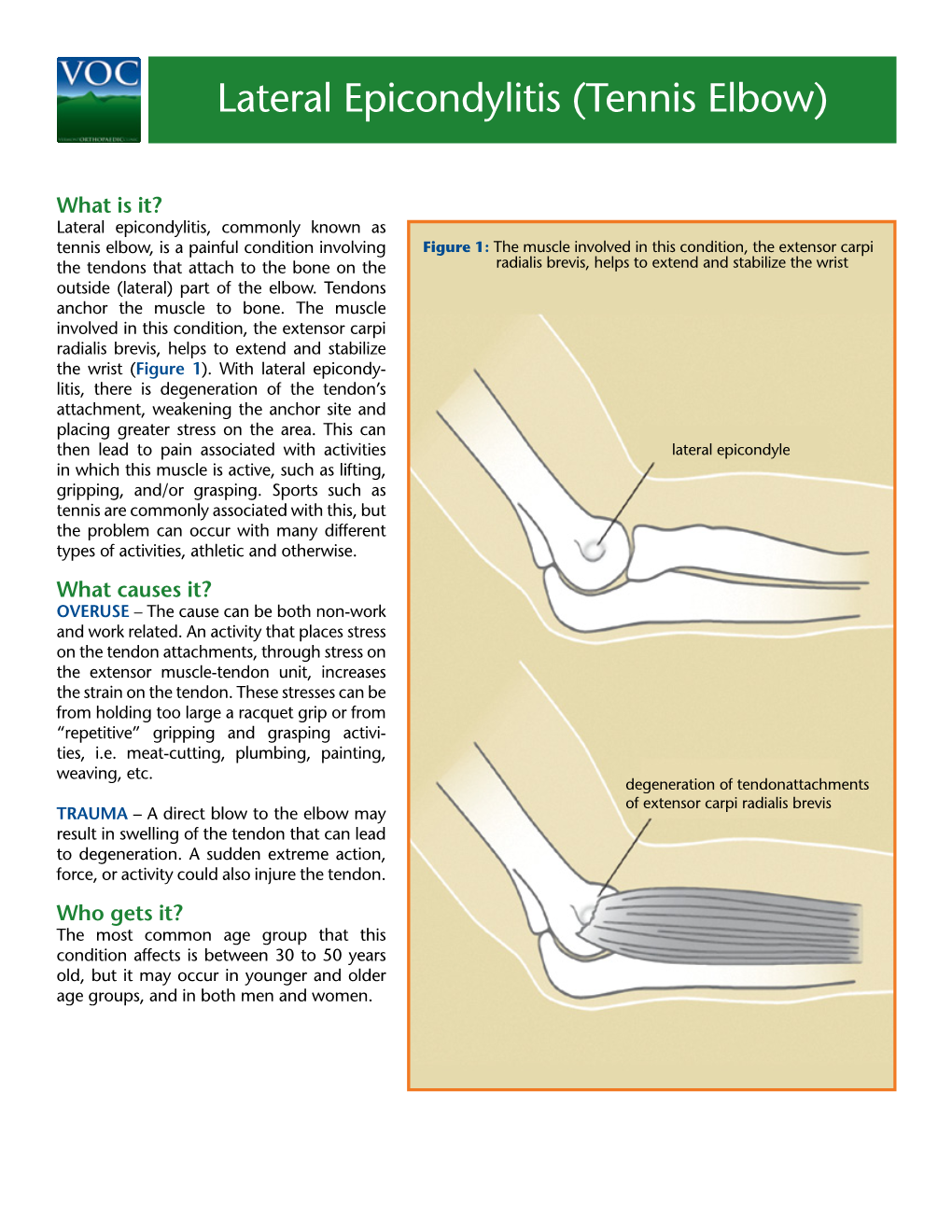 Lateral Epicondylitis (Tennis Elbow)