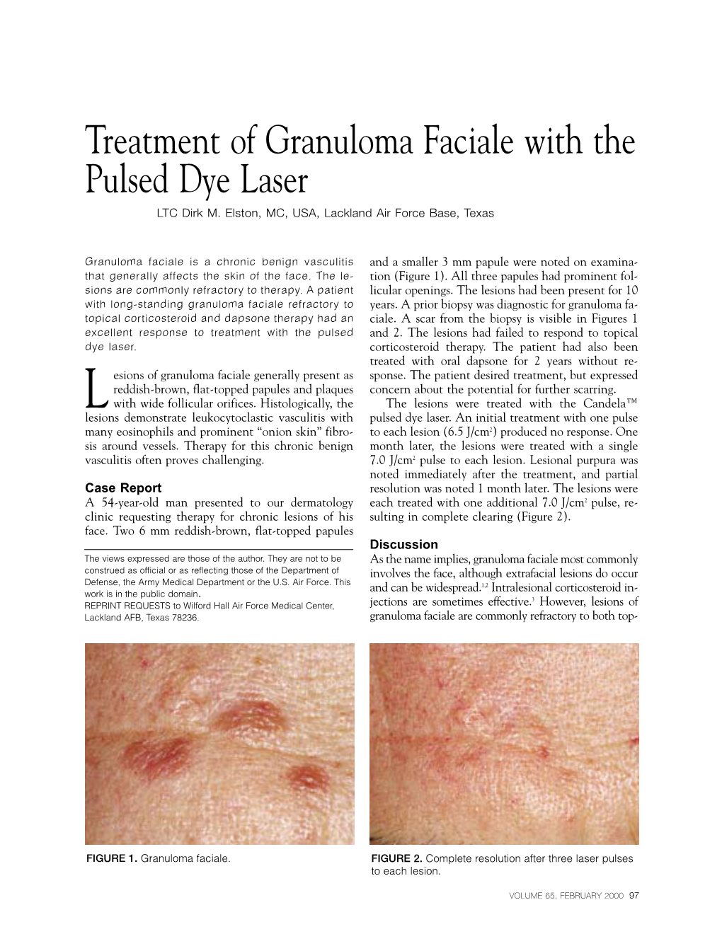 Treatment of Granuloma Faciale with the Pulsed Dye Laser LTC Dirk M