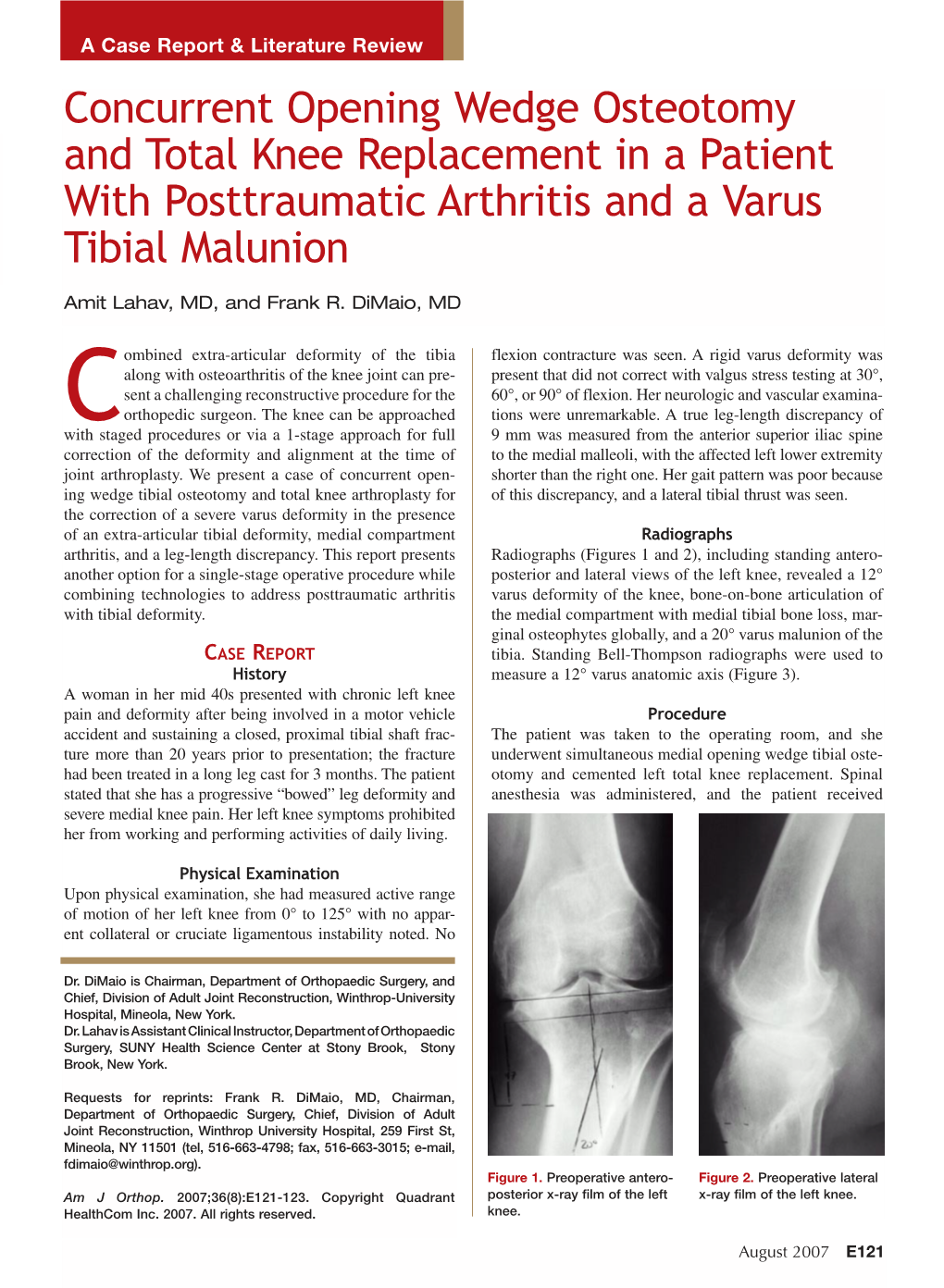 Concurrent Opening Wedge Osteotomy and Total Knee