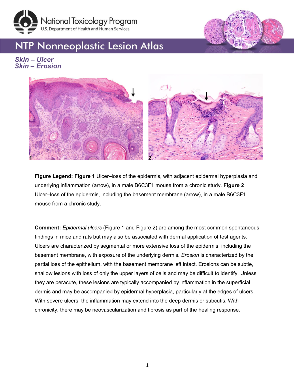 Skin – Ulcer Skin – Erosion - DocsLib