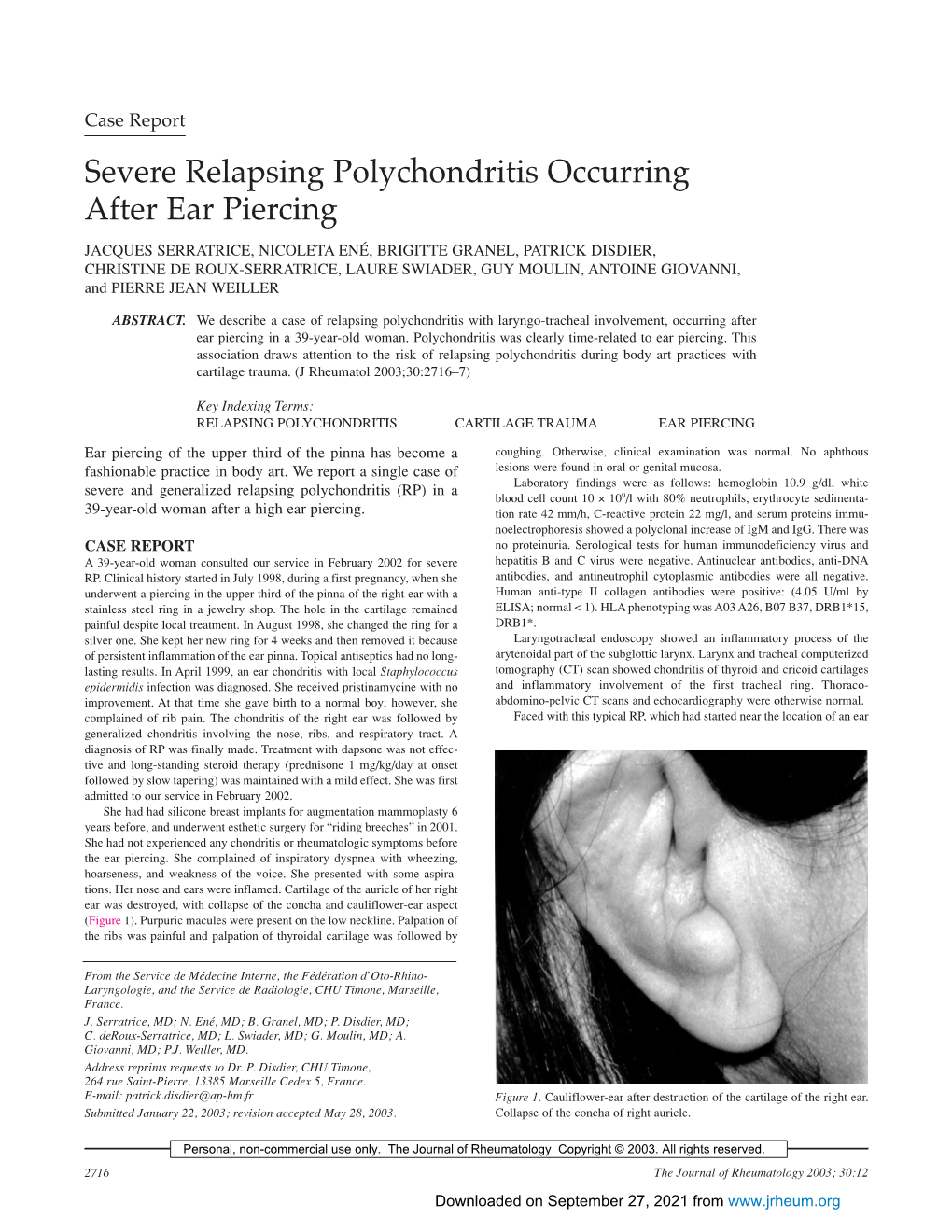 Severe Relapsing Polychondritis Occurring After Ear Piercing