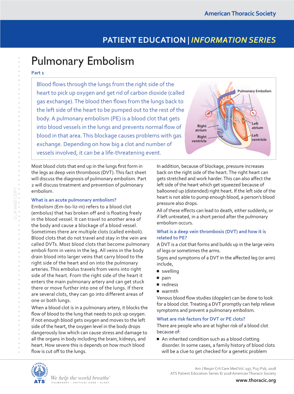 Pulmonary Embolism