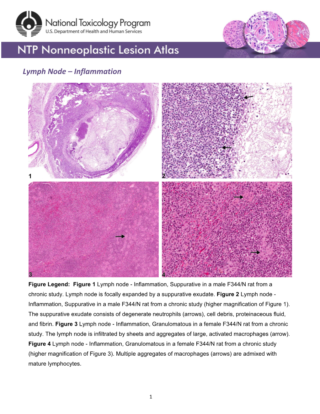 Lymph Node – Inflammation