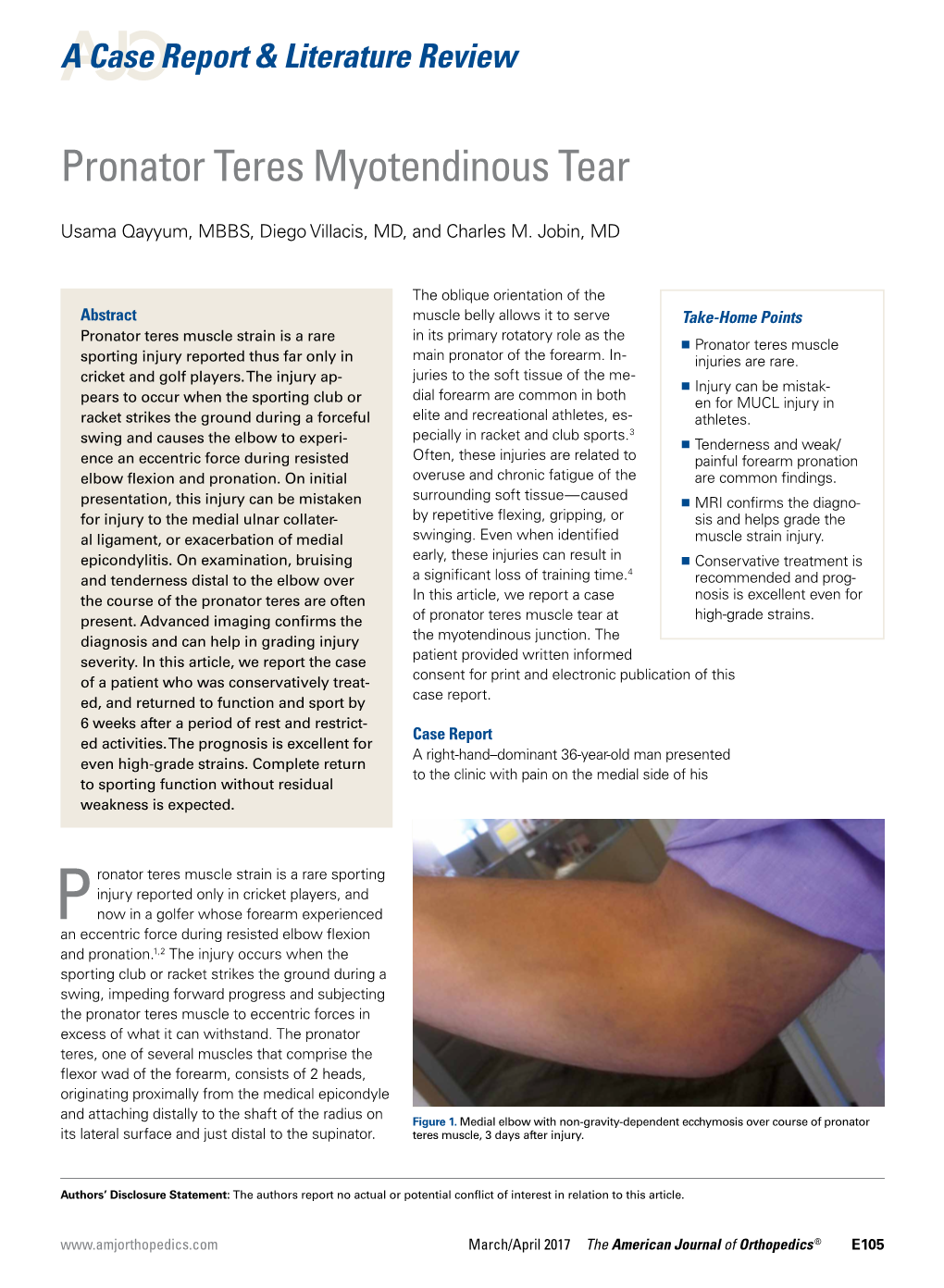 Pronator Teres Myotendinous Tear