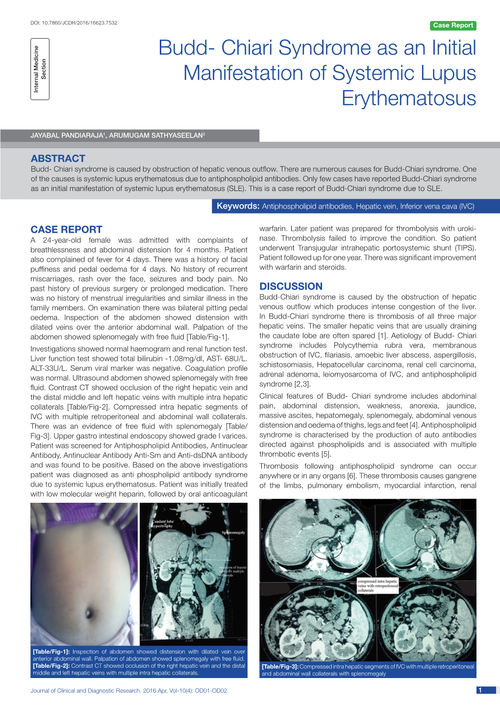 Chiari Syndrome As an Initial Manifestation of Systemic Lupus Erythematosus (SLE)