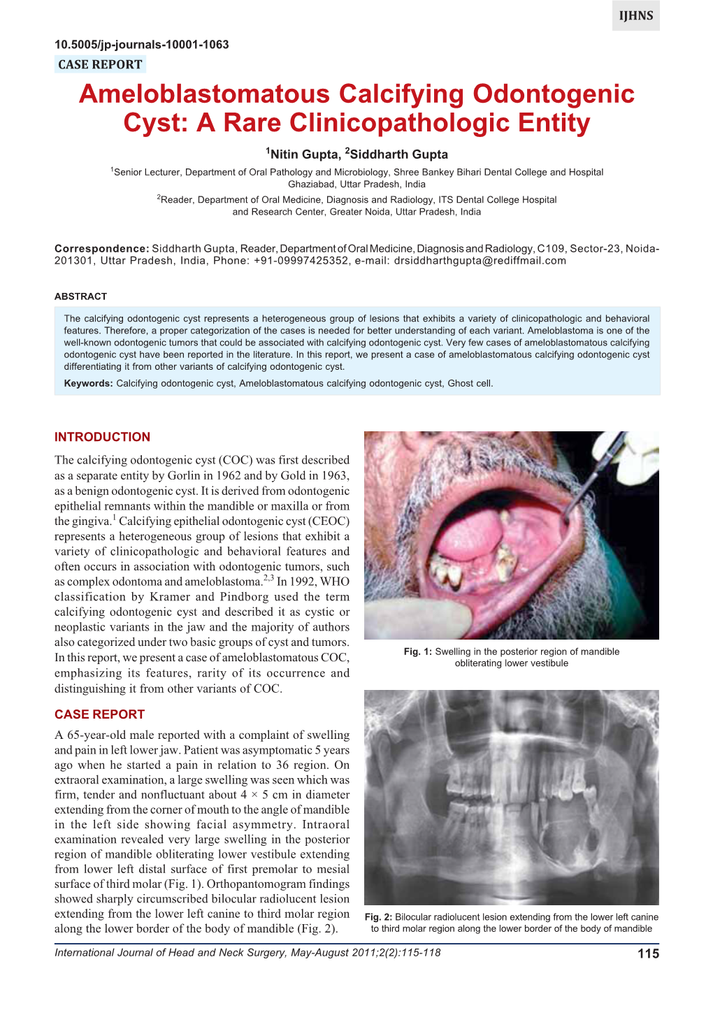 Ameloblastomatous Calcifying Odontogenic Cyst