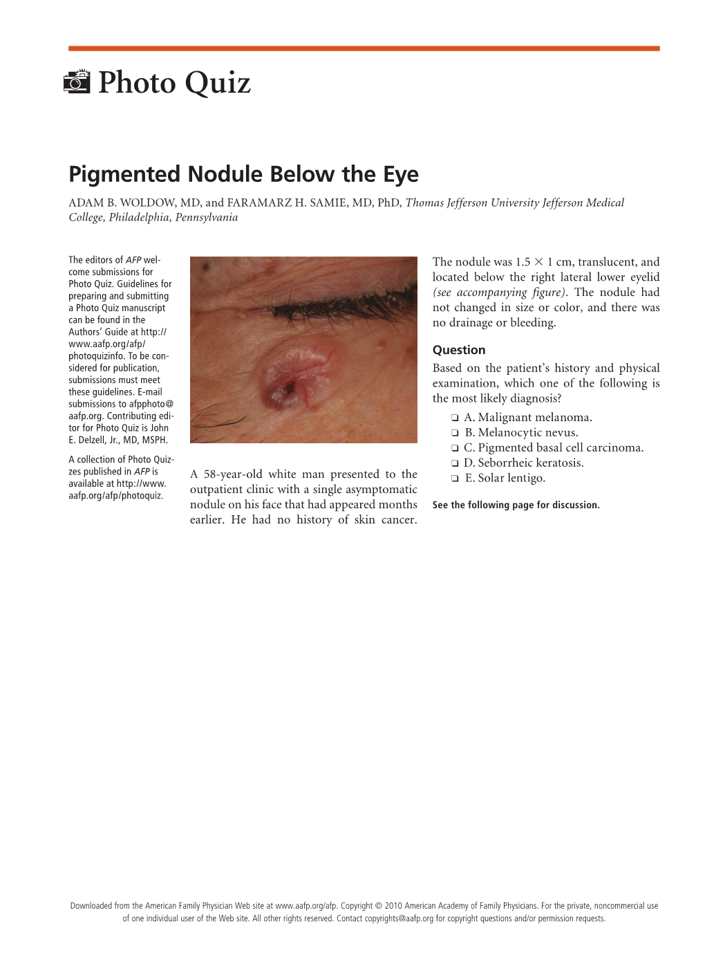 Pigmented Nodule Below the Eye ADAM B