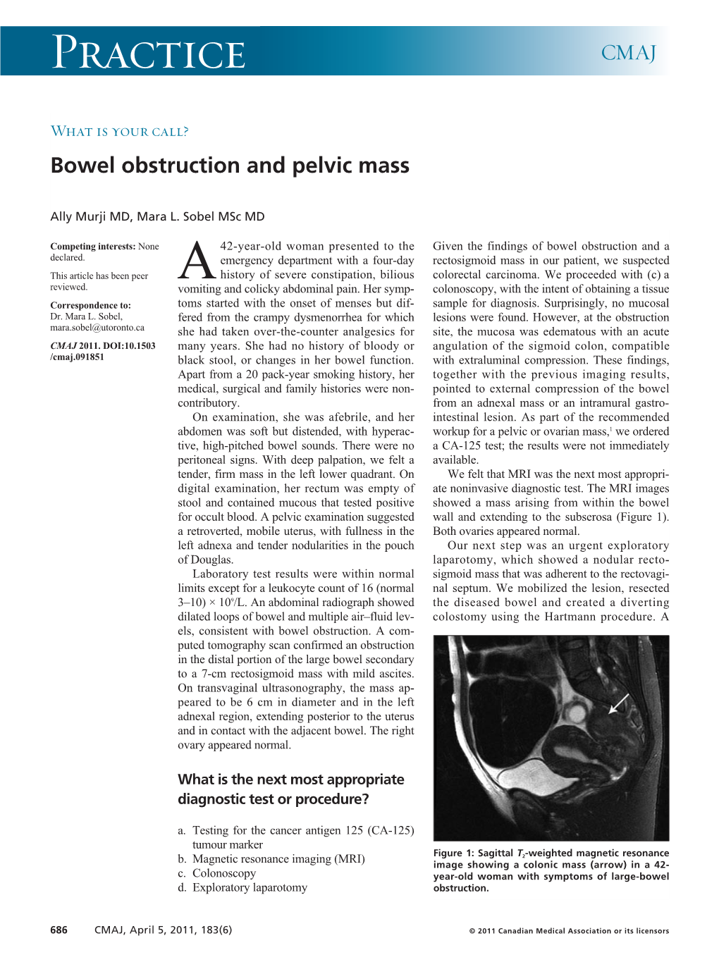 Bowel Obstruction and Pelvic Mass